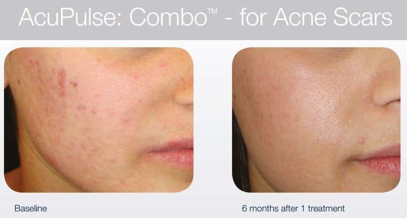 Bikini photos at the lake Facial rejuvenation central coast